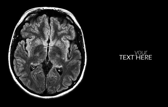 Brain MRI scan on the black