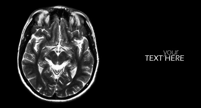 Brain MRI scan on the black