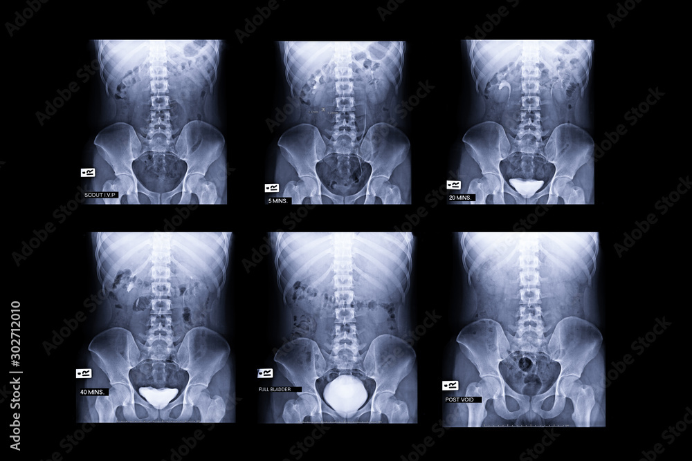 Poster procedure of intravenous pyelogram or ivp is an x-ray exam of urinary tract after injection contrast