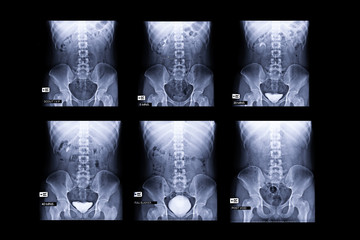 procedure of Intravenous pyelogram or IVP is an X-ray exam of urinary tract after injection...