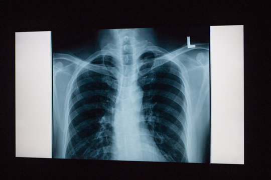 xray of a chest