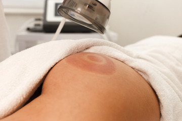 Cosmetologist makes buttock vacuum massage procedure for client closeup. Doctor uses endomassage...