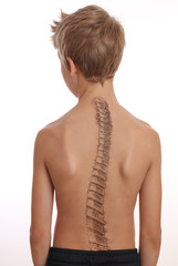 Scoliosis Spine Curve Anatomy, Posture Correction. Chiropractic treatment, Back pain relief.