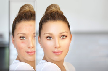 Post-Acne Marks /Treating Acne Scars.Acne Scar Removal
