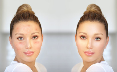 Post-Acne Marks /Treating Acne Scars.Acne Scar Removal