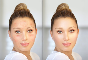Post-Acne Marks /Treating Acne Scars.Acne Scar Removal