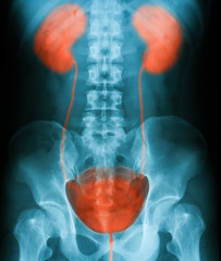 X-ray image of Urinary tract infection, urolithiasis disease in kidney-ureter-bladder 