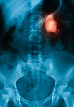 X-ray image of urinary tract (kedny, urenary and bladder: KUB), Showing left kidney stone and infection.