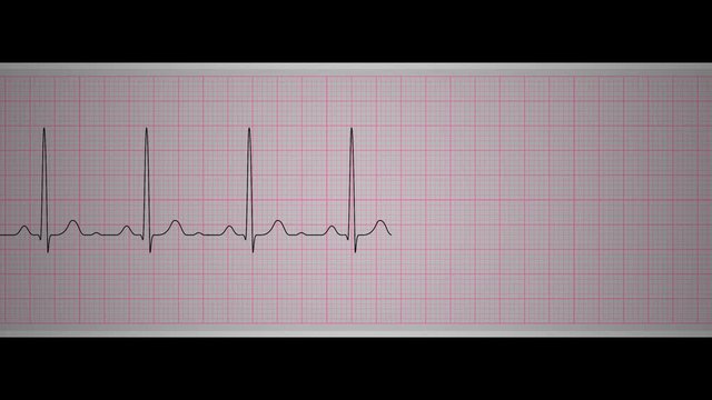 Ecg Track Normal Sinus