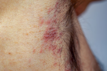 Extreme close-up photography of the atocpic dermatitis symptoms on  the right armpit of an adult...