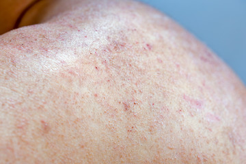 Fototapeta premium Extreme close-up photography of the atocpic dermatitis symptoms on the left shoulder of an adult male.