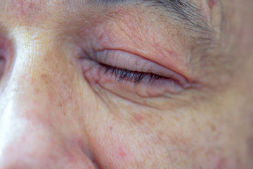 Extreme close-up photography of the atocpic dermatitis symptoms on the left eye of an adult male.