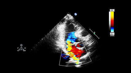 Screen of echocardiography (ultrasound) machine.