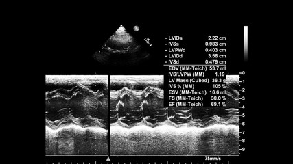 Screen of echocardiography (ultrasound) machine.