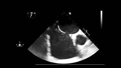 Screen of echocardiography (ultrasound) machine.