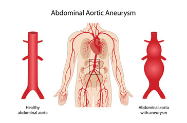 Abdominal aortic aneurysm. Arterial circulatory system of the abdominal. Healthy abdominal aorta and abdominal aorta with aneurysm. Vector illustration in flat style isolated on white background - obrazy, fototapety, plakaty