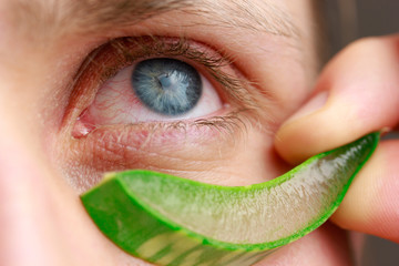 a man healing his irritated blue eye stroking with aloe vera slice gel closeup dry skin redness...