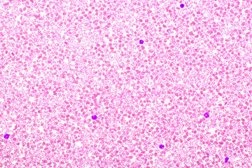 Picture of white blood cell, red blood cell and platelet in blood film, analyze by microscope, 400x 