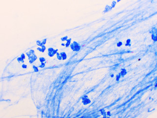 Mycobacterium tuberculosis positive (small red rod) in sputum smear, acid-fast stain, analyze by microscope