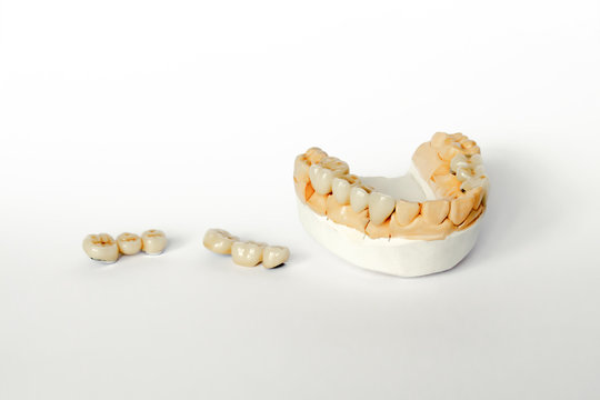 orthopedic dentistry. tooth replacement concept. dental prosthetics. cermet teeth. ceramic bridges. gypsum model of the jaw and teeth. White background