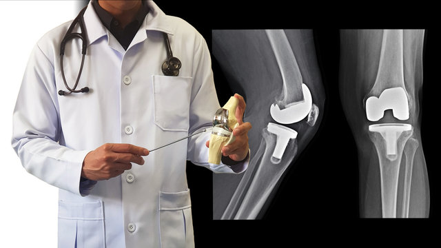 Orthopedic doctor giving information on treatment osteoarthritis disease (OA knee) by surgery with Total Knee Replacement(TKR) prosthesis. Film X ray show joint implant. Medical technology concept.