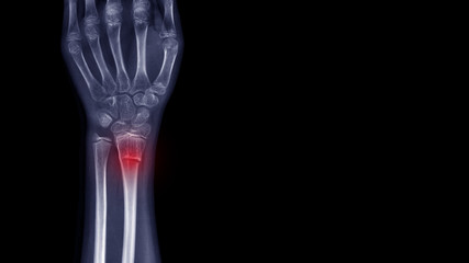 Film X-ray wrist radiograph show wrist bone broken (torus or buckle fracture) from falling....