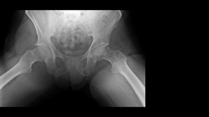 Film X ray hip radiograph show femoral head collapse form bone infarction or avascular necrosis (AVN) or Osteonecrosis (ON) disease with progressive arthritis joint. Medical diagnosis concept.