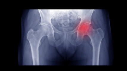 Film X-ray hip radiograph show Left femoral head collapse form Avascular necrosis (AVN) or Osteonecrosis (ON) disease. Right hip show osteoarthritis  joint disorder(OA). Medical technology concept. - obrazy, fototapety, plakaty