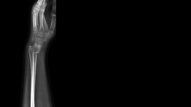 Film X ray wrist radiograph show children bone broken (torus or buckle fracture). The patient has wrist pain, swelling and deformity. Medical imaging and technology concept