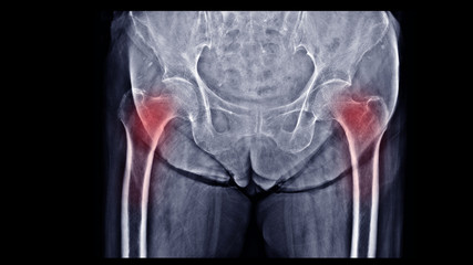 Film X-ray hip show osteoporosis bone. The elderly patient has Osteoporosis disease. Highlight on loss bone density area that decrease strength and increase risk of broken. Fall precaution concept. 
