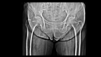 Film X-ray hip show osteoporosis bone. The elderly patient has Osteoporosis disease that loss bone density, weaken bone strength and increase risk of broken. Fall prevention and precaution concept. 