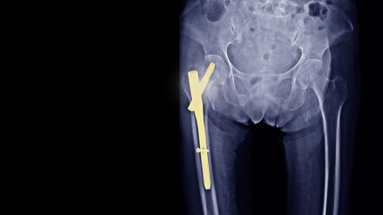 Film X-ray pelvis show hip bone broken(intertrochanteric femur fracture) treated by operative...