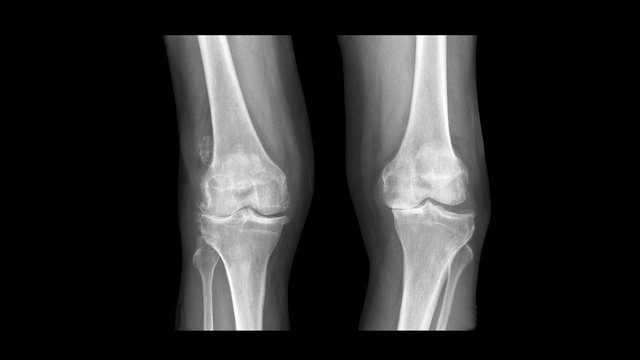Film X ray knee radiograph show degenerative osteoarthritis disease (OA knee disorder) with Windswept deformity (Varus deformity on right knee and Valgus on left side). Medical investigation concept