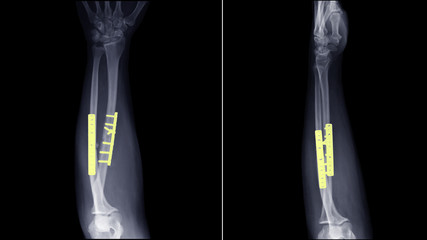 Film X-ray forearm radiograph show forearm both bone broken(shaft of Ulna and Radius fracture)...