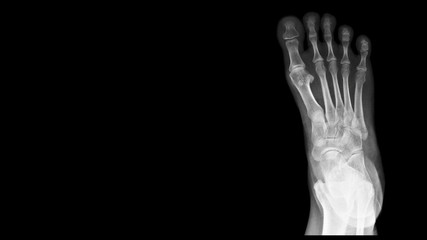 Film foot X ray radiograph show toe bone broken ( base of metatarsal fracture or Jones fracture ) from fall from ladder. The patient has foot pain and swelling. Medical imaging concept 