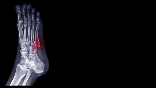 Film foot X ray radiograph show toe bone broken ( base of metatarsal fracture or Jones fracture ) from against the wall. Highlight on fracture site and painful area. Medical technology concept 