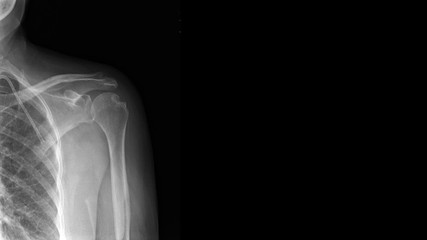 Film X ray shoulder show Hill-Sachs lesion. Hill Sachs lesion is posterolateral humeral head...