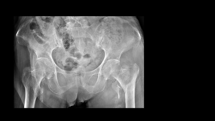 Film X ray hip radiograph show broken hip bone (intertrochanteric fracture of femur). Elderly patient has osteoporosis and accidental fall at home. medical care and fall prevention concept.