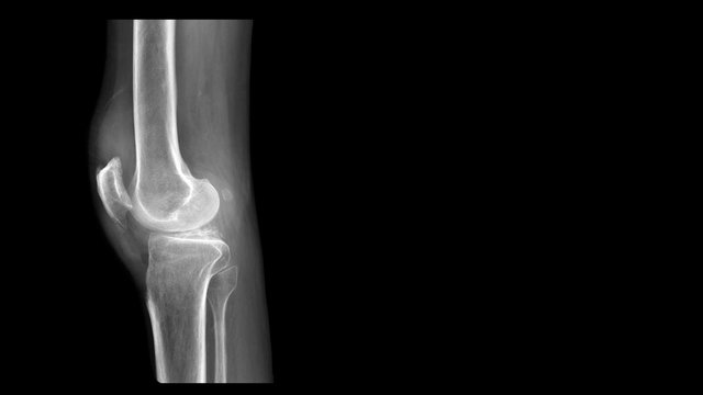 Film X ray knee radiograph show Os Fabella. Fabella is a small bone embedded in tendon. This is accessory bone which anatomical variation present in 39% of human population. Medical imaging concept