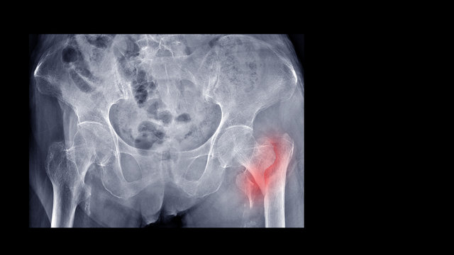 Film X-ray Hip Radiograph Show Broken Hip Bone (intertrochanteric Fracture Of Femur). Elderly Patient Has Osteoporosis And Accidental Fall At Home. Nursing Care And Fall Prevention Concept.