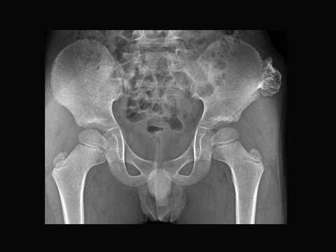 Film X-ray pelvis radiograph show Osteochondroma disease at left pelvic bone. Osteochondrama is the most common benign tumor of bone. Medical imaging concept