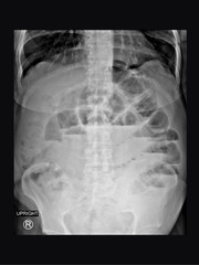 Film x-ray upright abdomen radiograph show small bowel dilatation and different air fluid level in...