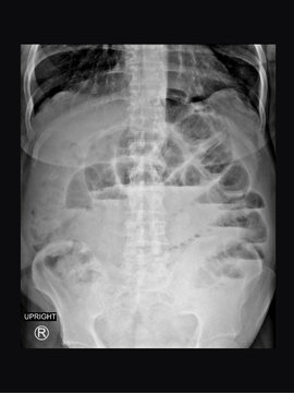Film x-ray upright abdomen radiograph show small bowel dilatation and different air fluid level in same loop (step-ladder sign). The patient has gut obstruction from hernia disease. medical concept