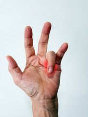 Trigger finger disease (locking finger or stenosing tenosynovitis disorder), hand anatomy with...