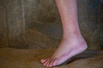 An elderly man with bare legs draws an iodine grid at the site of a tumor and a bruise on his leg. Injured leg, simple home treatment, red iodine.