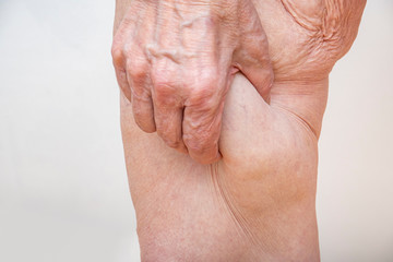 A senior woman holding, pulling a lot of excess loose skin on legs after weight loss, gastric...