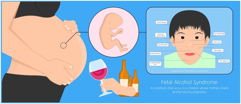Fetal alcohol spectrum syndrome disorders conditions mother drank during pregnancy cause brain damage and birth defect in children