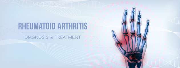 Horizontal rheumatoid arthritis hand sore joints concept for social media