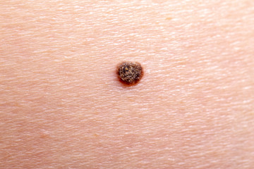 The initial stage of melanoma
