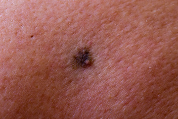 The initial stage of melanoma